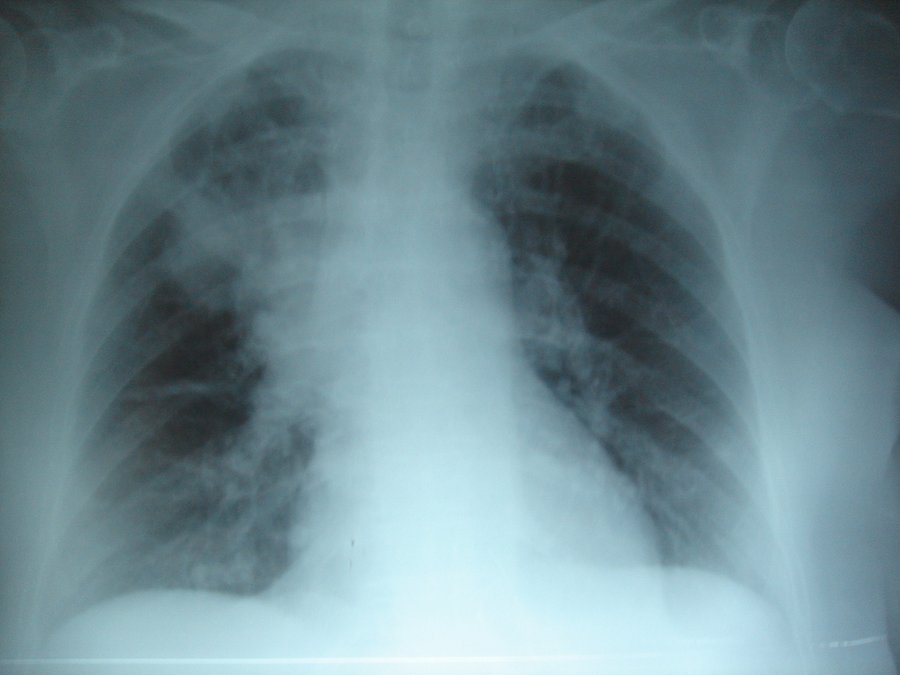 Zapalenie płuc przy mukowizcydozie