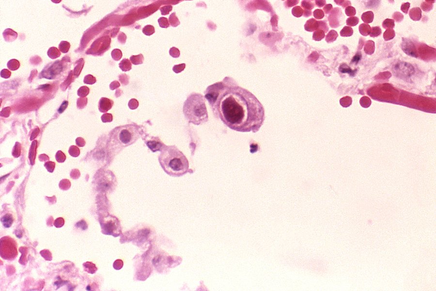 Cytomegalovirus w płucach
