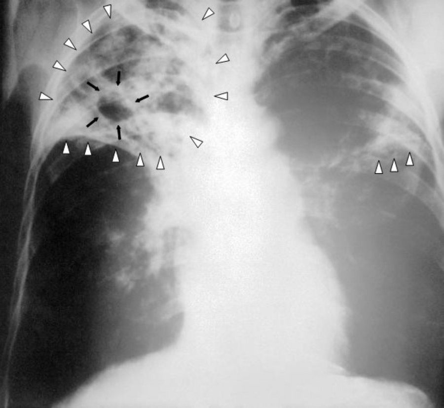 Gruźlica płuc na prześwietleniu