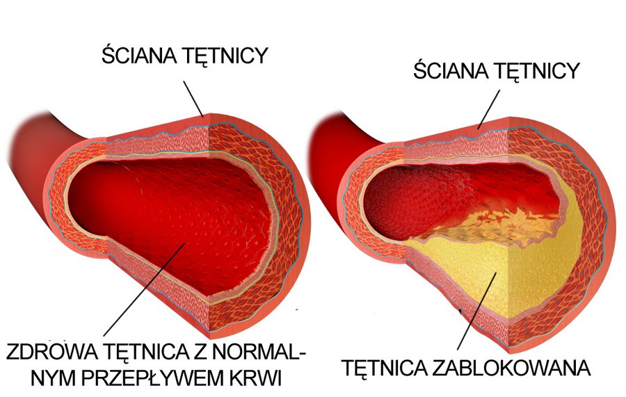 Miażdżyca tętnic - ilustracja zdrowej i zablokowanej tętnicy
