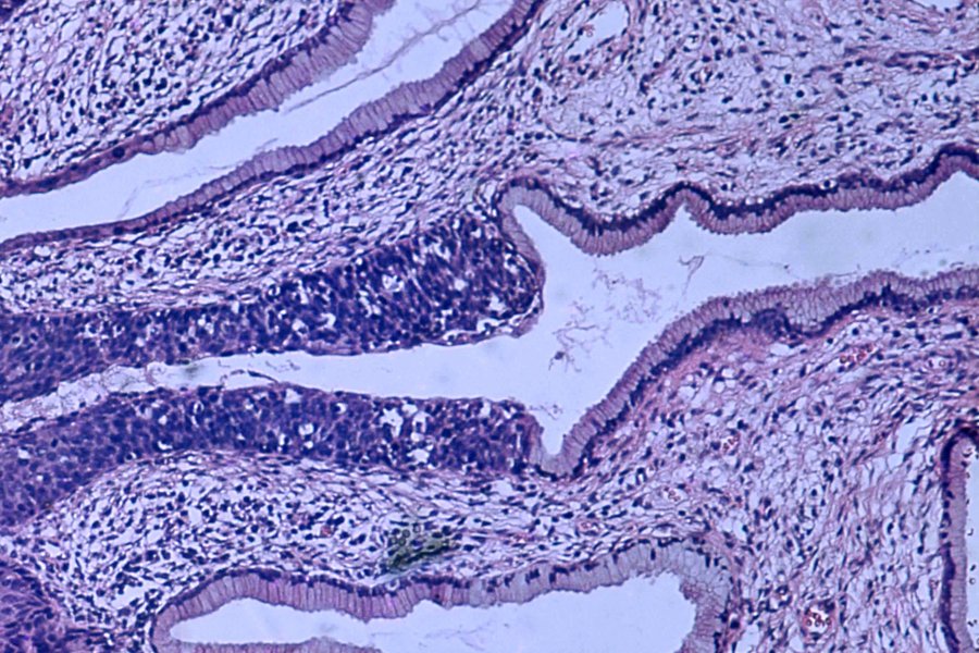 Rak szyjki macicy - obraz histopatologiczny