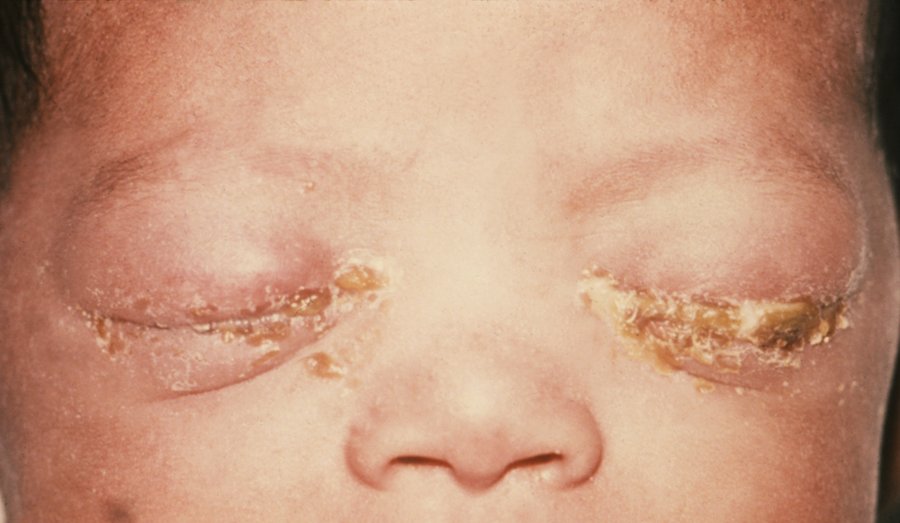 Zapalenie okolic oczu u noworodka od rzeżączki