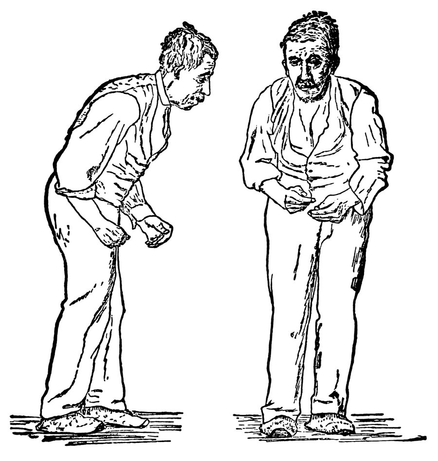 Ilustracja pokazująca osobę chorą na Parkinsona